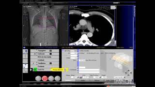 Angiotac Arterias Coronarias Siemens Somatom 64 multidetectores [upl. by Berky792]