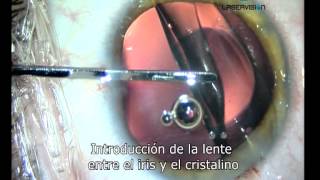 Lente intraocular para el tratamiento de la miopia hipermetropia y astigmatismo [upl. by Normac]