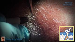 White Hair removal [upl. by Dennet]