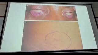 COMPLICACIONES de las FRACTURAS  sd compartimental aplastamiento  TRAUMATOLOGÍA  AUDIO BUENO [upl. by Lodge]