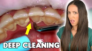 Deep Cleaning With HEAVY Tartar Build Up At The Dentist [upl. by Canice]