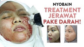 Beberapa Treatment Untuk Hilangkan Bekas Jerawat  Skincare 101 [upl. by Chung]