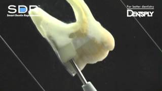 SDR®  Selfleveling Bulk Fill Composite  Dentsply Sirona [upl. by Ettigdirb]