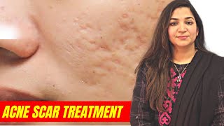 How To Treat Acne Scars  Acne Scar Treatment by Dr Aisha Ghias acne acnescars [upl. by Rivy]