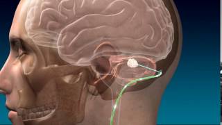 Deep Brain Stimulation for Stroke Recovery Animation [upl. by Hermie]