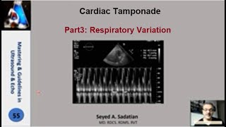 Cardiac tamponade Part 3 Respiratory Variation [upl. by Malkah]