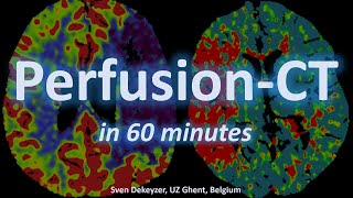 PerfusionCT in acute ischemic stroke in 60 minutes [upl. by Vincents]