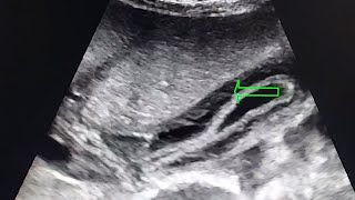 Hepatitis A sonographic features [upl. by Gnouhc87]