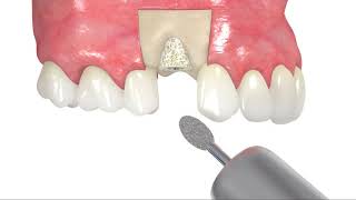 Augmentacja kości przy pomocy maxgraft bonering [upl. by Sell]