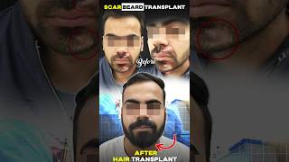 Beard Transplant In Scar With URFUE Method  Beard Transplant Before amp After beardtransplant [upl. by Eiuol]