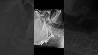 Demonstrates postoperative fixation amp occipitocervical instrumentation stabilizing odontoid fracture [upl. by Onitsuaf747]