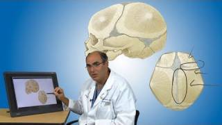 Craniosynostosis and its treatment  Boston Children’s Hospital [upl. by Outhe]