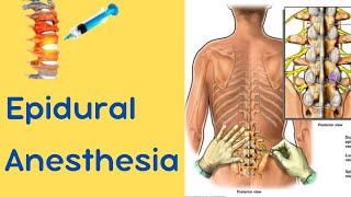 Epidural Anesthesia [upl. by Gildas]