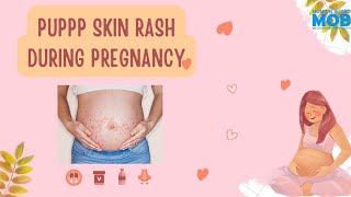 PUPPP Skin Rash During Pregnancy  SMOB [upl. by Schinica]