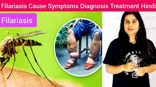 Filariasis Cause Symptoms Diagnosis Treatment in Hindi  Filariasis Cause by  What is Filariasis [upl. by Enihpad]