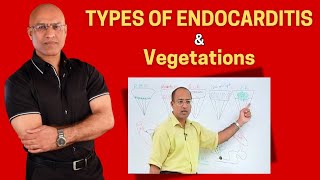 Endocarditis Types and Vegetations  Cardiology🫀 [upl. by Orat]