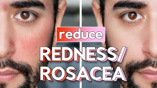 Red Skin amp Rosacea On Face  Skin Care Routine Hacks amp Fixes ✖ James Welsh [upl. by Jolie]