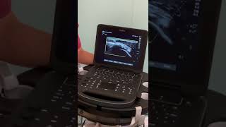 UltrasoundGuided Barbotage for Calcific Tendonitis  Kent MSK Clinic [upl. by Tengler]