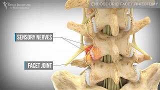 Endoscopic Facet Rhizotomy  Spine Institute of North America [upl. by Nyleuqcaj246]