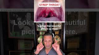 STREP THROAT Symptoms [upl. by Niko]