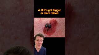 When should I see a doctor about a mole shorts health skin cancer [upl. by Devan]