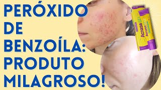 Peróxido de Benzoíla  Produtos para Acne que FUNCIONAM EP 01 🙌🏻 [upl. by Meldoh204]