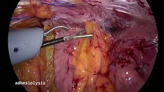 Lparoscopic Hartmann Reversal Metin Ertem MDFACS [upl. by Greeley]