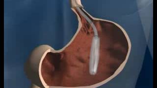 Gastric Balloon Placement [upl. by Seabrook629]