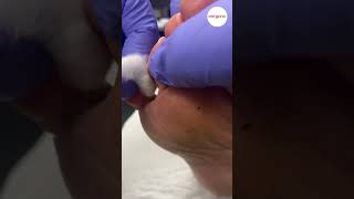 Pinch Callus Tyloma Removal [upl. by Popele]