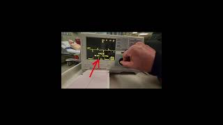 Transcutaneous Pacing TCP [upl. by Dallis175]