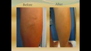 Varicose Veins for Sclerotherapy 靜脈曲張注射治療 Before and After Treament [upl. by Gavrila]