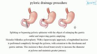 pyloric drainage procedure [upl. by Anibla236]