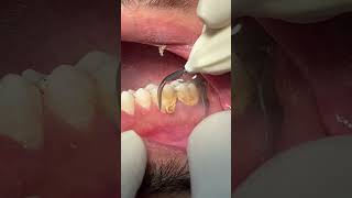 Cleaning teeth 🦷 dental scaling satisfying [upl. by Harday]