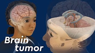 What is Craniopharyngioma [upl. by Brittani]