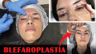 MINHA BLEFAROPLASTIA PREÇO RECUPERAÇÃO RESULTADO 3 MESES [upl. by Kristofor]