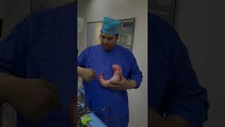 What is removed in sleeve Gastrectomy drrksingh bariatric definitecure obesity [upl. by Llednek]