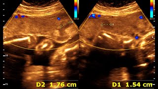 25 weeks 0 days pregnancy  Normal pregnancy  Placental lake [upl. by Teplica]