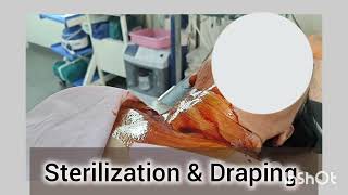 Stellate Ganglion Injection under Fluroscopy by DrVishal Gunjal at Nashik Pain Care Centre [upl. by Irroc]