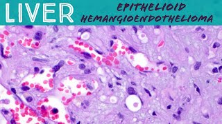 Rare Liver Tumor  Epithelioid hemangioendothelioma Basic soft tissue pathology [upl. by Anihsak]