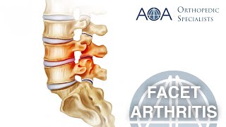 AOA Orthopedic Specialists  Facet Arthritis [upl. by Reemas]