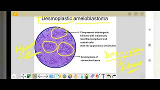 Ameloblastoma shaffer desmoplastic histopathology dr Ankit Meelleelaeduhub313 [upl. by Martinsen]