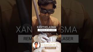 Xanthelasma Removal by CO2 Laser  Fat deposit removal treatment xanthelasma shortvideo skincare [upl. by Elnar]