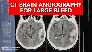 BRAIN HEMORRHAGE  CT SCAN ANGIOGRAPHY [upl. by Eipper618]