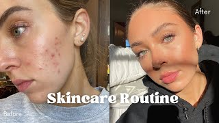 The skincare routine that changed my life [upl. by Ferguson58]