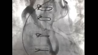 Subclavian venogram before pacemaker implantation [upl. by Bury544]