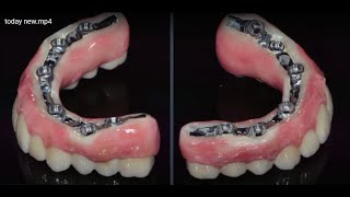 Full arch case in a patient with skeletal class 3 relationship [upl. by Acinat]