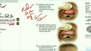 Ophthalmology Trachoma شرح بالعربى الرمد الحُبيبي التراخوما [upl. by Rambort]