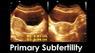 Primary Subfertility  Sonographic prediction  Practical ultrasound female Pelvic [upl. by Shapiro]