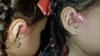 Life Update My 2 yr old has Preauricular Sinus Infections [upl. by Eremihc277]