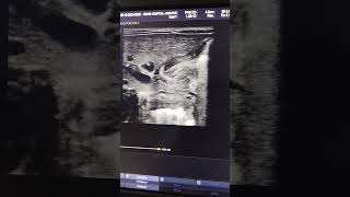 Congenital hypertrophic pyloric stenosis in neonates ultrasoundscans baby [upl. by Ellohcin]